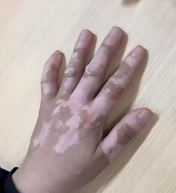 白癜风：不只是“白斑”，揭开皮肤上的神秘面纱