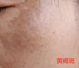 不同类型色斑的治疗与预防指南