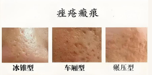 增生性瘢痕与凹陷性痤疮瘢痕：科学治疗全解析