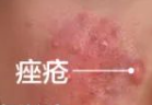 痤疮 vs. 玫瑰痤疮：你真的分清楚了吗？