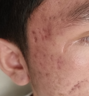 红痘印→黑痘坑？62%的人踩中护理雷区！皮肤科医揭「战痘后遗症」3阶段拯救法