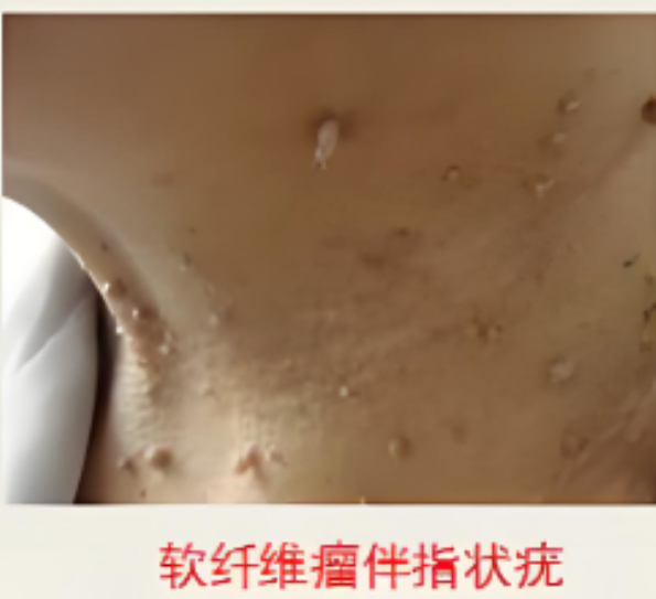 有一种疣叫寻常疣！