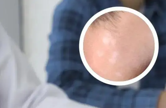 白癜风并非“不治之症”！科学防治指南助你击破皮肤“褪色”危机