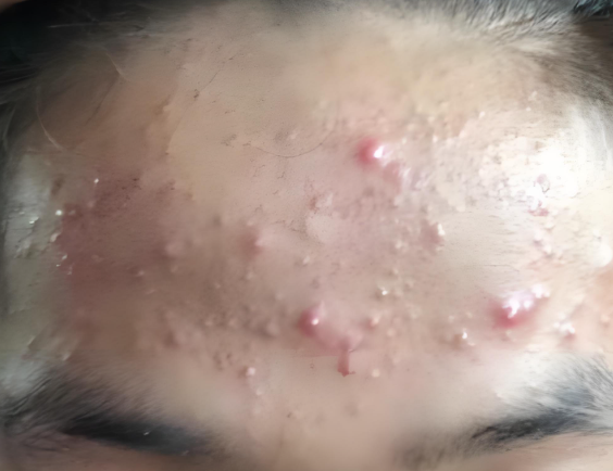 额头痘痘反复难消？破解成因，科学应对