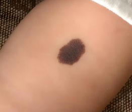 生命初始的特殊“印记”：关于胎记的科学解读