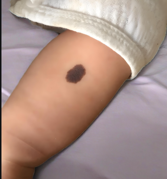 胎记：是“天使之吻”还是健康警报？一文读懂胎记的秘密！