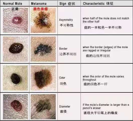 皮肤科常见的几种肿瘤疾病