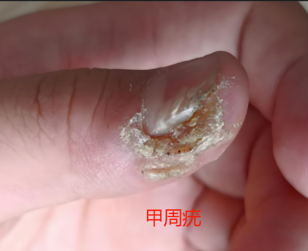 有一种疣叫寻常疣！