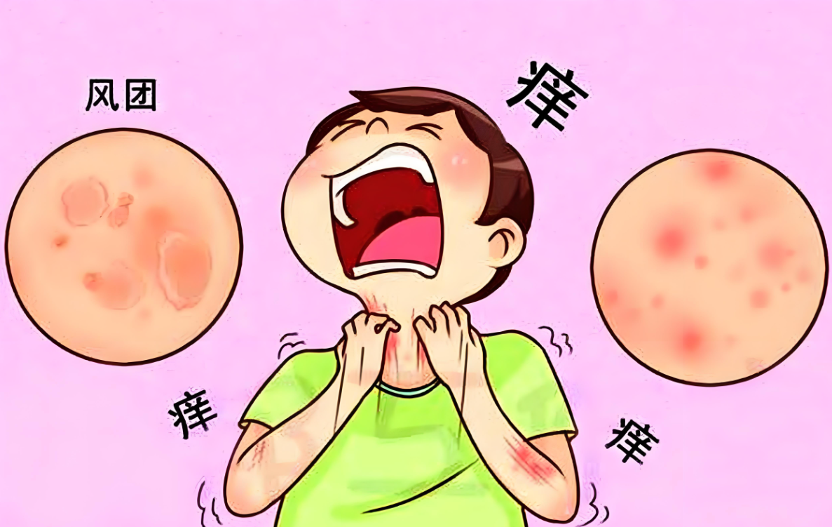 荨麻疹：皮肤上的“神秘警报”，皮肤科医生教你科学应对！