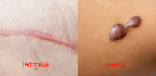 曲安奈德联合肉毒素与CO₂激光治疗瘢痕的综合策略与临床实践
