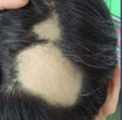 斑秃究竟是什么病？
