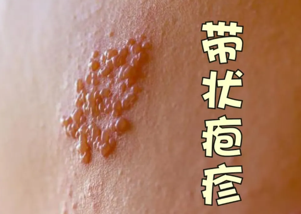 皮肤疹子困扰？夏季如何应对？