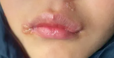 皮肤疹子困扰？夏季如何应对？