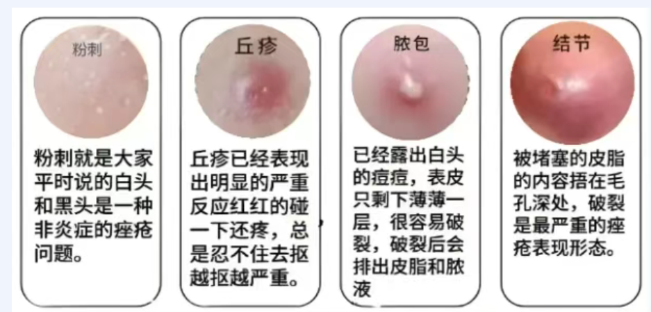 痤疮（痘痘）困扰怎么办？