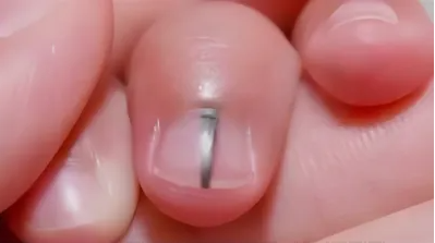 指甲上出现黑线，是痣还是癌？