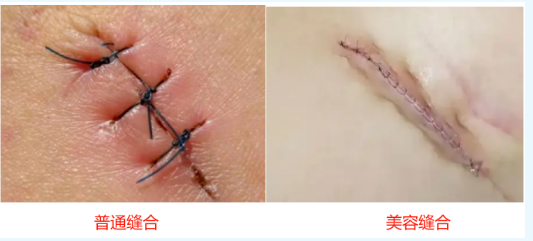 外科缝合VS美容缝合：如何选择才能不留疤？