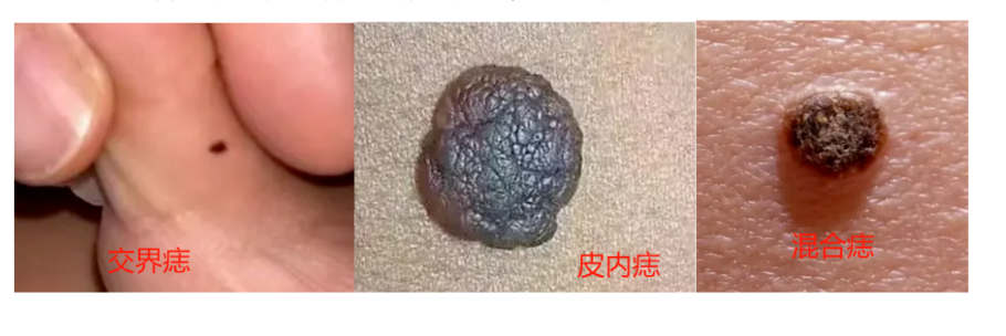 色素痣：一站式服务！