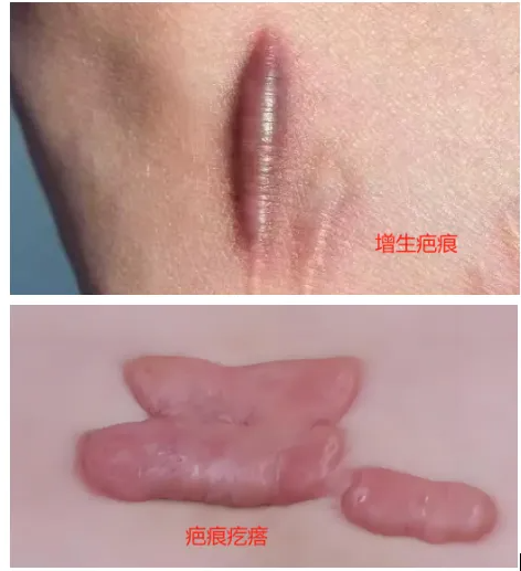 抚平疤痕：皮肤科的美容激光